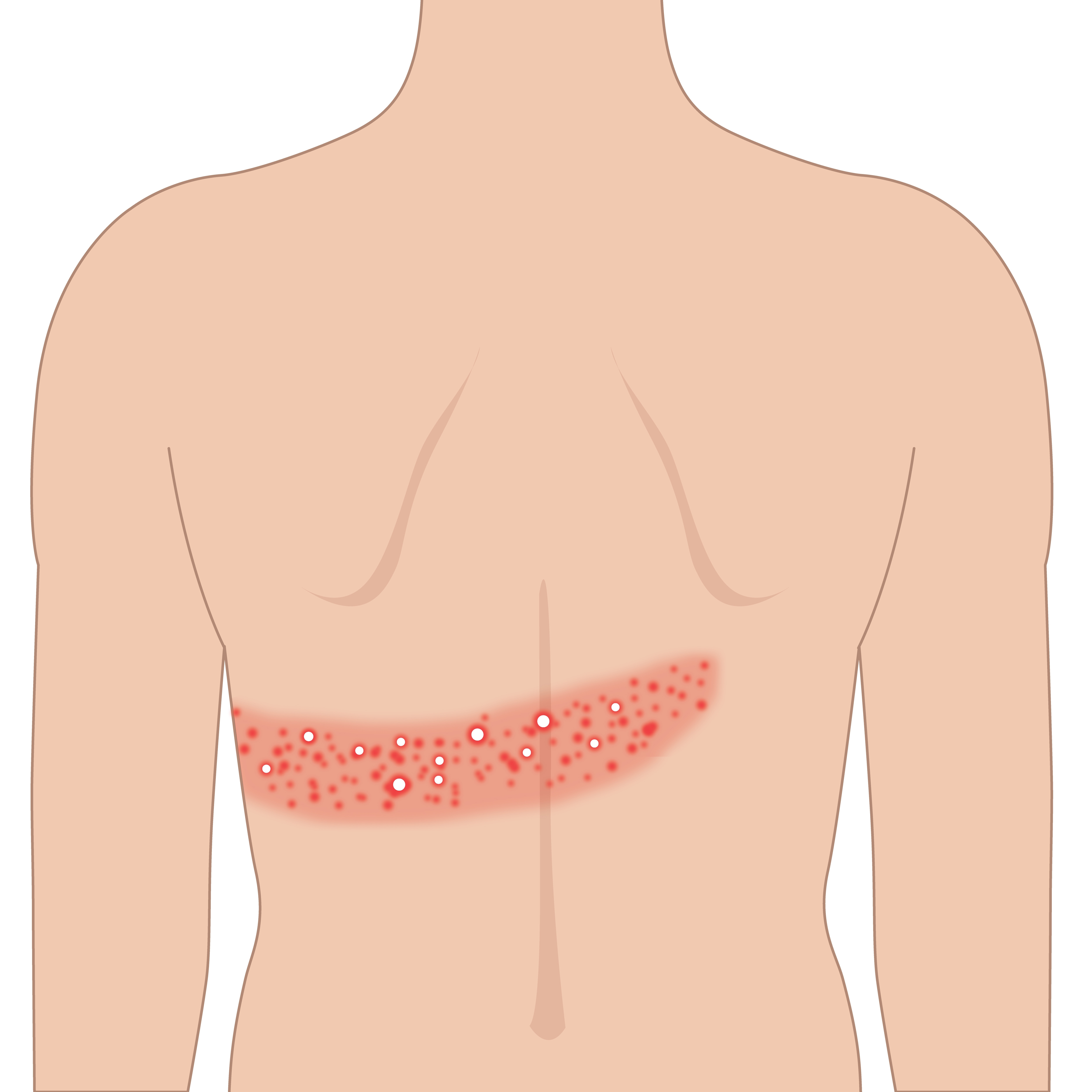 to get shingles